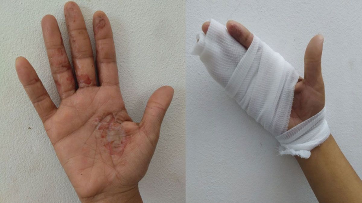 ওষুধ নেই, পচন ধরছে গাজার নারীদের হাতে