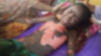 জ্বরের ‘ভুল ওষুধে’ ঝলসে গেল শিশুর শরীর, ফার্মেসি বন্ধ করে পালালেন ‘চিকিৎসক’