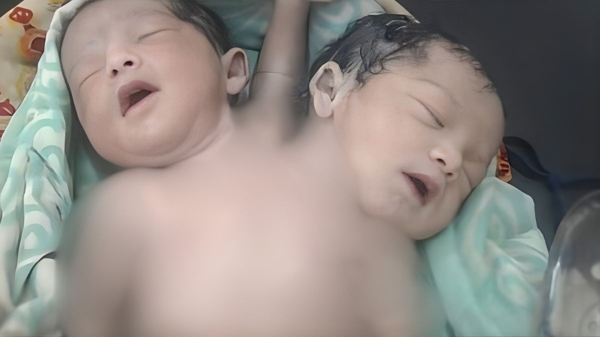 নওগাঁয় দুই মাথা, তিন হাত নিয়ে নবজাতকের জন্ম