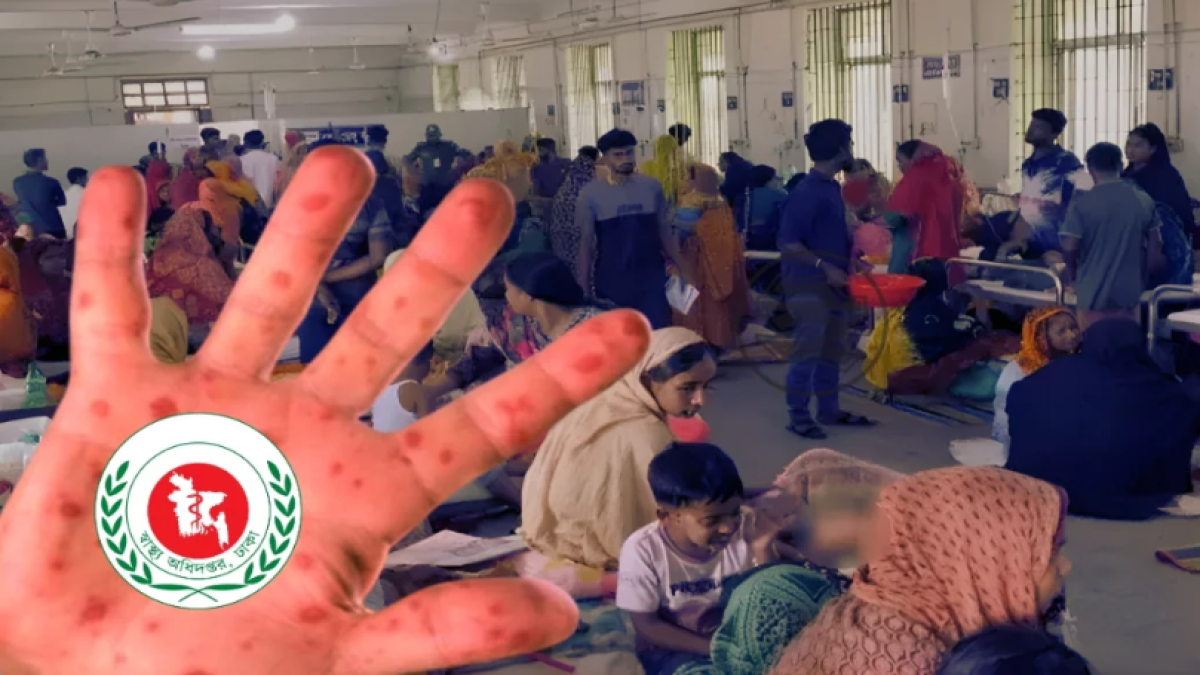 হাম উপসর্গে আরও ৩ শিশুর মৃত্যু, আক্রান্ত ১০৮০